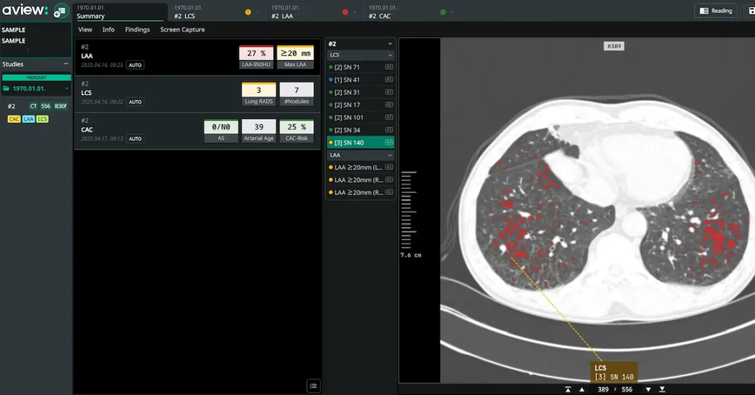 An interface of Coreline Soft's lung cancer screening analysis software
An interface of Coreline Soft's lung cancer screening analysis software