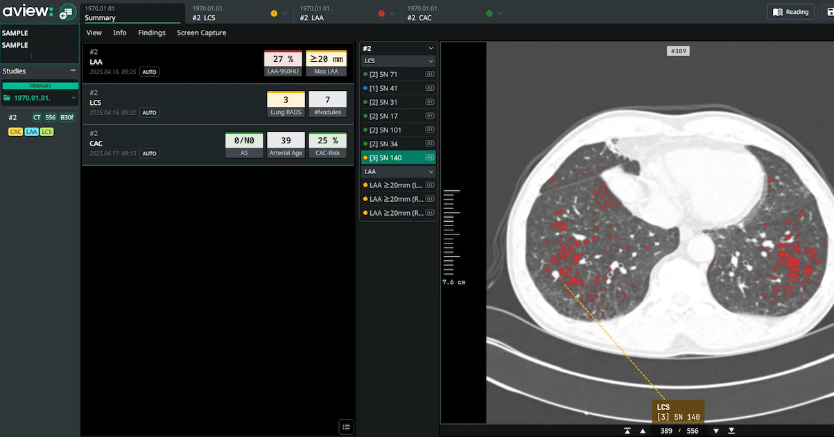An interface of Coreline Soft's lung cancer screening analysis software
An interface of Coreline Soft's lung cancer screening analysis software